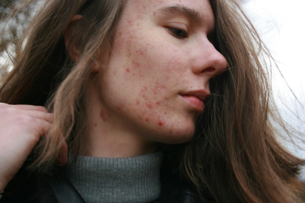 Acne: what it is and how it can be treated?