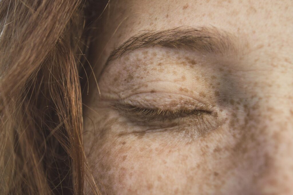 What is hyperpigmentation and how to get rid of it?