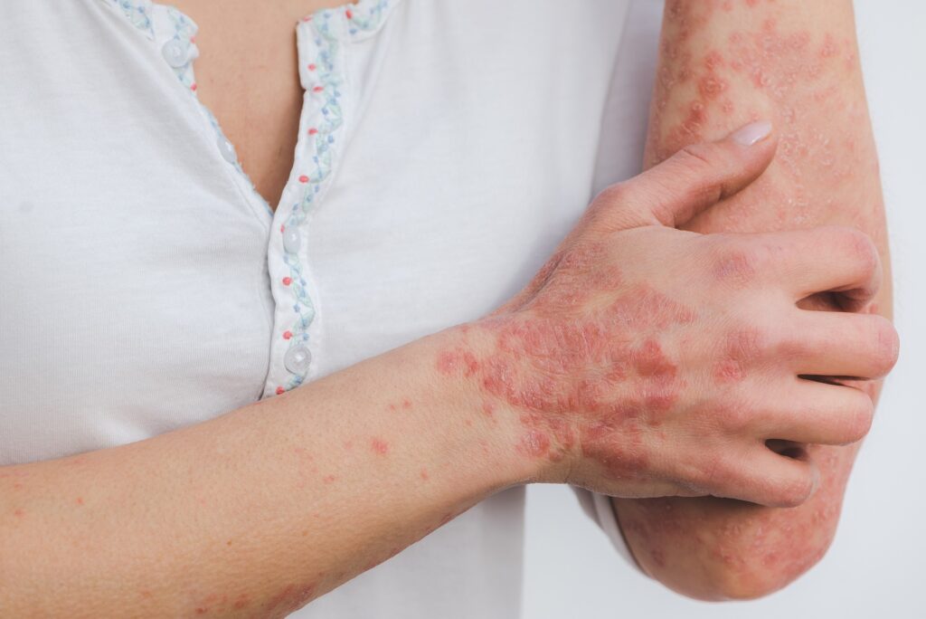 Managing Psoriasis Symptoms, Treatments, and Lifestyle Tips