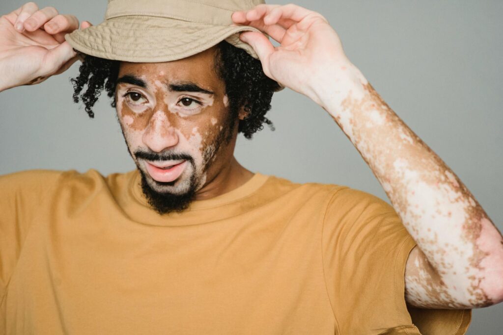 Understanding Vitiligo: Symptoms, Types, Causes, and Treatments