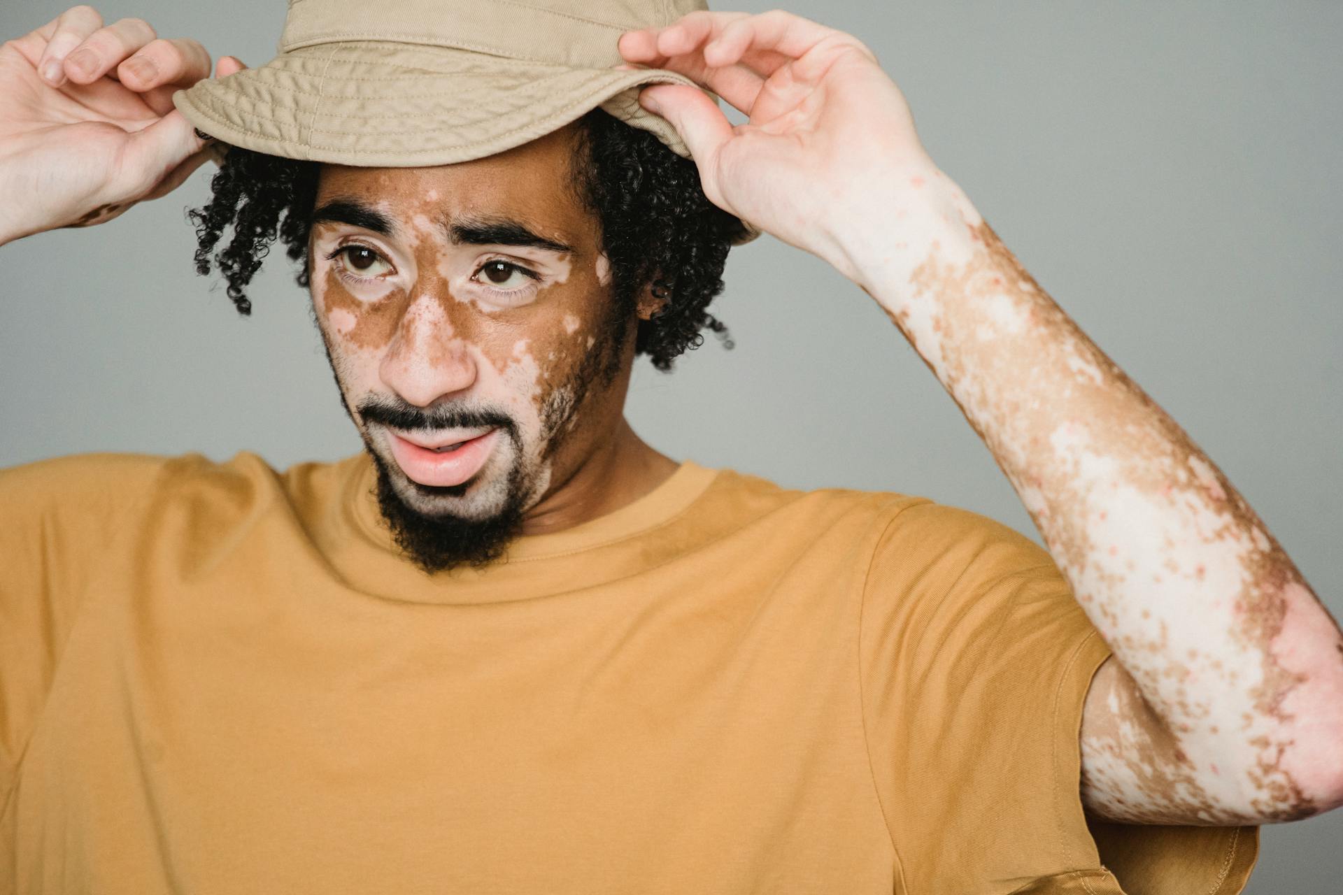 Understanding Vitiligo Symptoms Types Causes And Treatments 4137